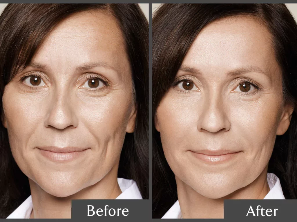 Skin Tightening Brisbane  How to achieve your desired results in 2023 -  Injex Clinics